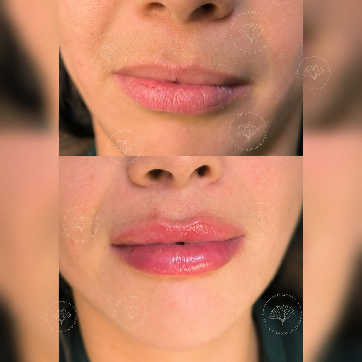 Preenchimento Labial — Clínica Blumet